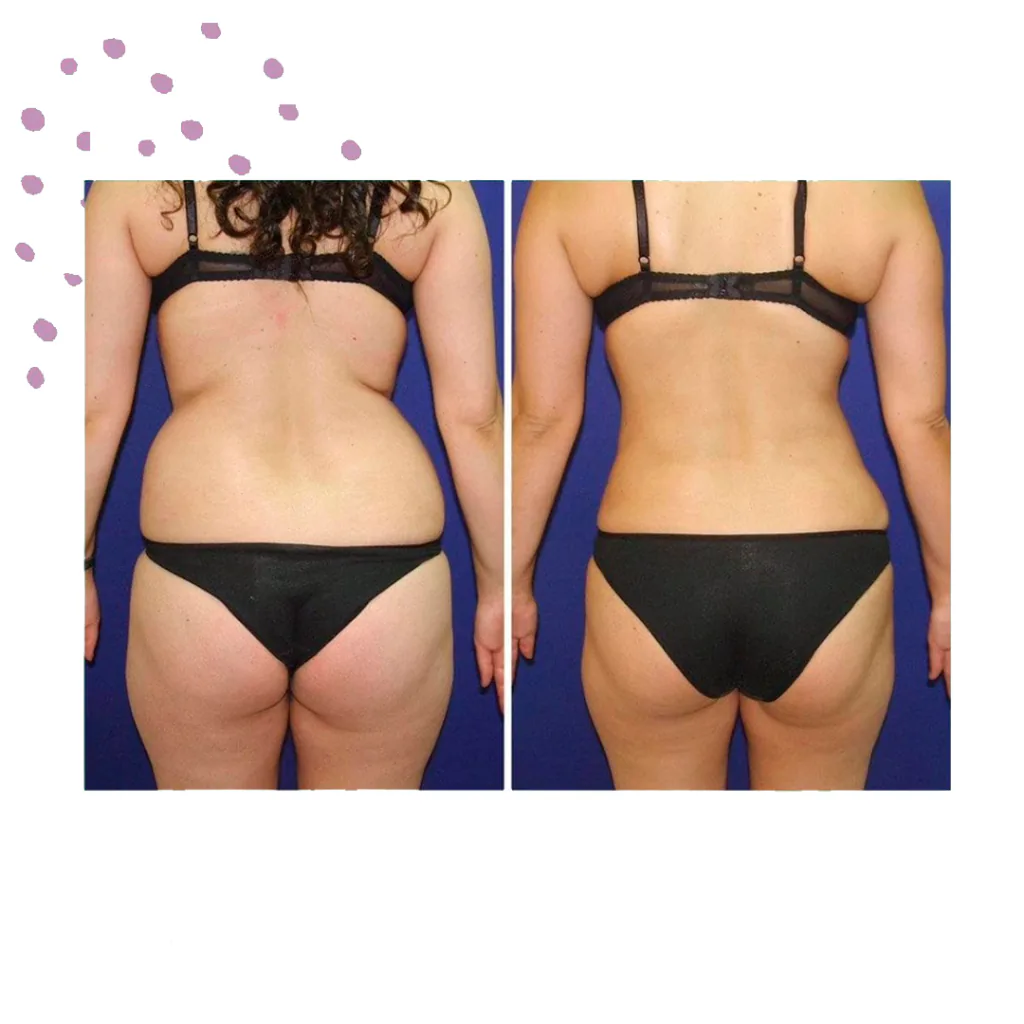 Resultado de adelgazamiento con el protocolo Slim Woman